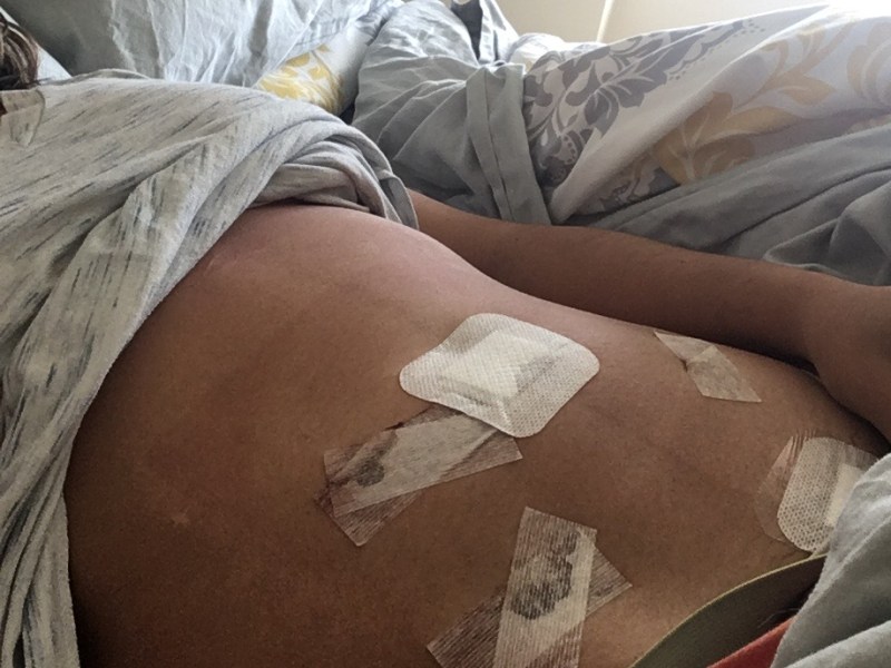 How I described pain as endometrial lesions spread throughout my&nbsp;body